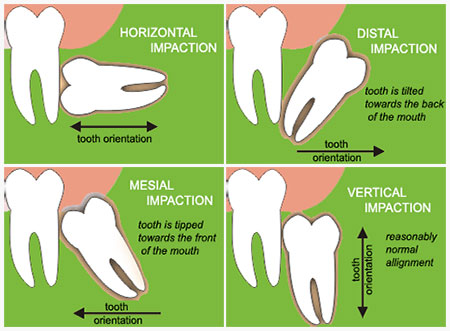 tooth extractions santa cruz